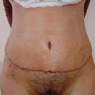3 Lipoaspiratie Si Abdominoplastie Dupa Interventie