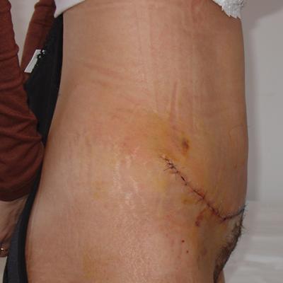 4 Lipoaspiratie Si Abdominoplastie Dupa Interventie
