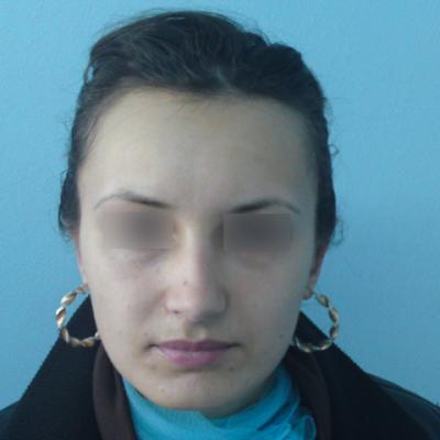 Otoplastie caz 1
