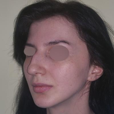 Rinoplastie inainte de interventie 4