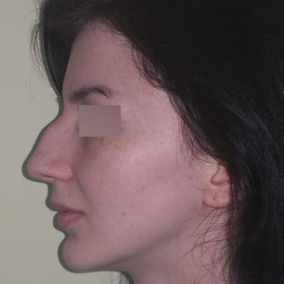 RInoplastie inainte de interventie 5