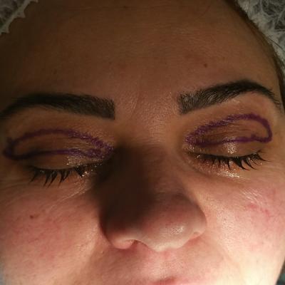 Blefaroplastie