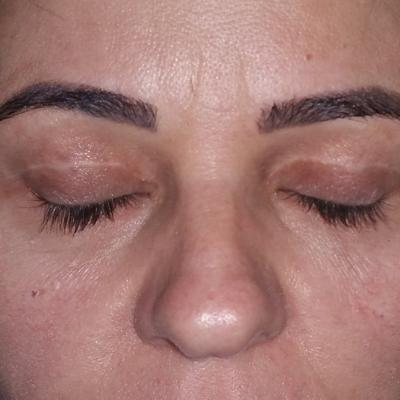 Dupa Blefaroplastie 2