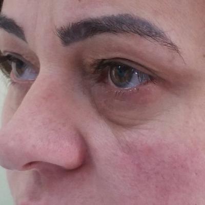 Inainte De Blefaroplastie 2