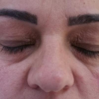 Inainte De Blefaroplastie